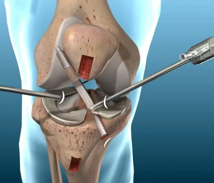 ACL Reconstruction Surgeon In Chennai ACL Surgery In Adyar Besant