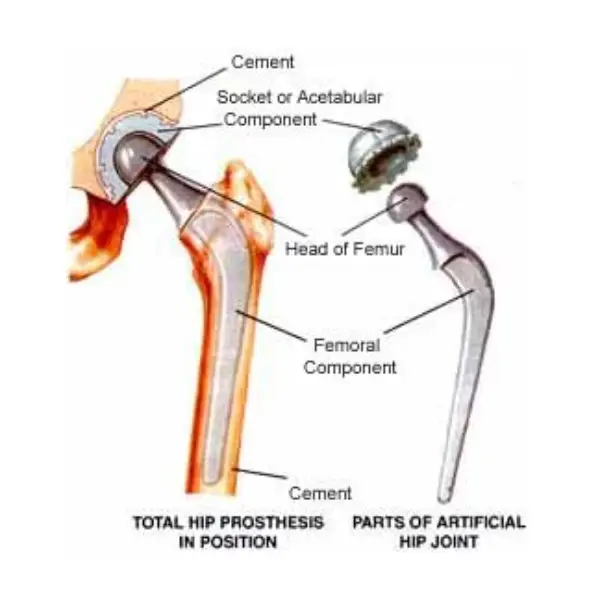 cemented hip replacement surgeon in chennai